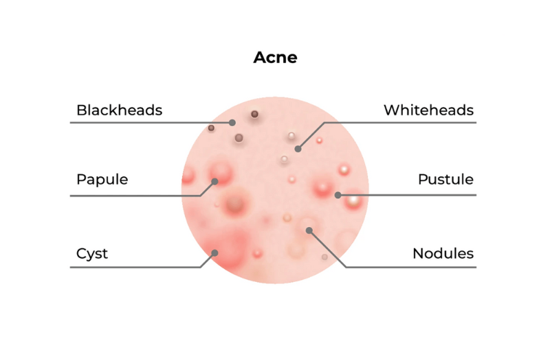 Diagram illustrating different types of acne