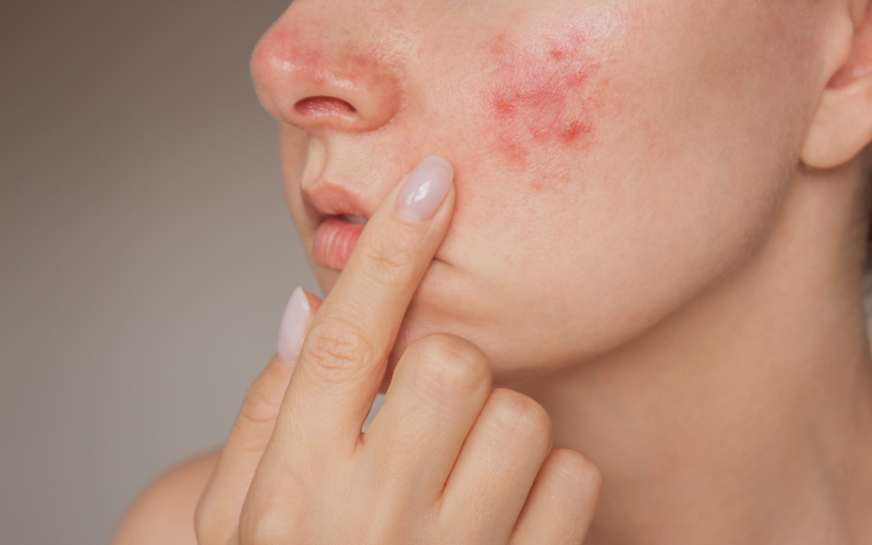 A close-up of a woman touching her rosacea-affected cheek